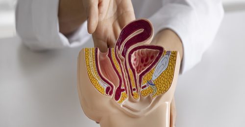 Polypectomy - ErcpBd